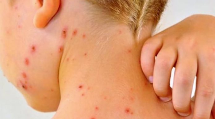 El sarampión es una de las enfermedades infecciosas más contagiosa del mundo. Foto: Ilustrativa